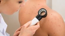 Lékaři zdarma vyšetří znaménka. Stany proti melanomu vyrostou po celém Česku