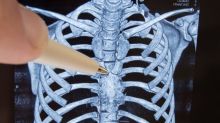 Lékaři nahradili část hrudní kosti a žeber implantátem z kovu, vyrobili ho na 3D tiskárně